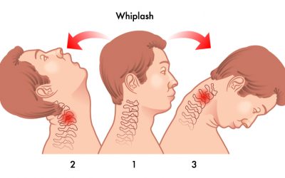 Did You Know Whiplash Can Occur at Low Speeds?
