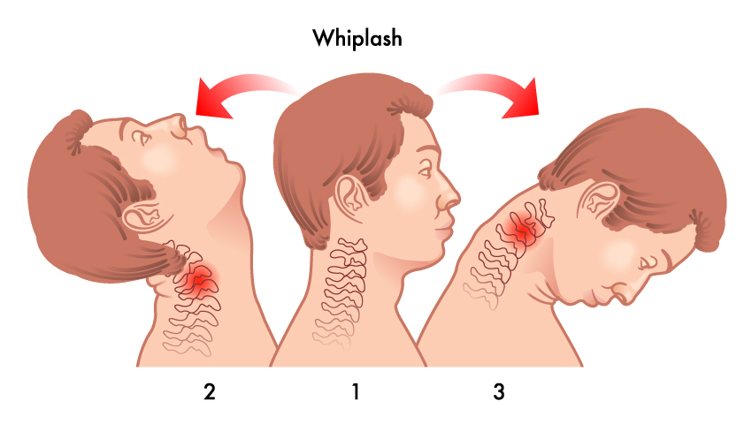 Did You Know Whiplash Can Occur at Low Speeds?